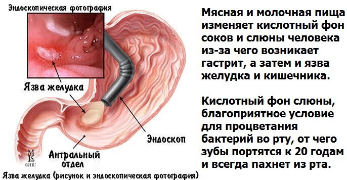 Как появляется гастрит, язва желудка и кишечника